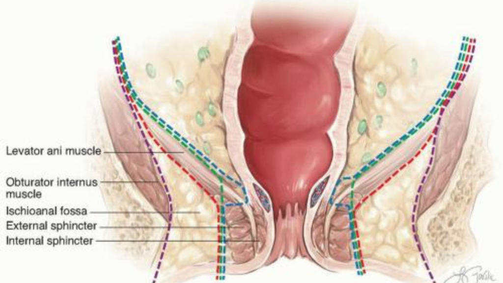 abdominoperineal resection in India