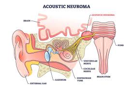 Best Acoustic Neuroma Treatment in India