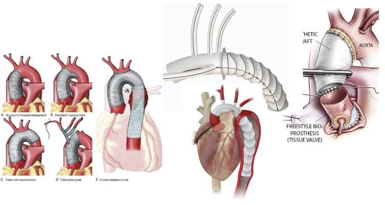 Aortic Root Replacement in India